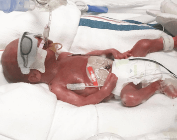 Heart of Minky: Jett, a premature baby born at 23 weeks, receiving care in a neonatal intensive care unit.